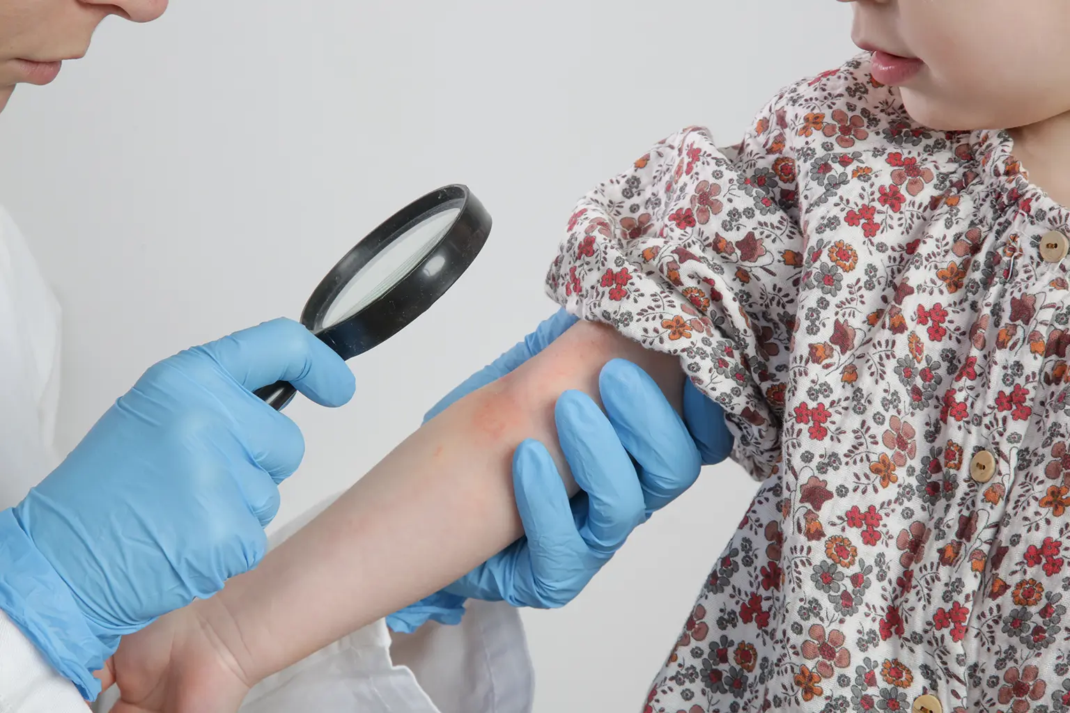 A doctor examines a rash on a child's arm closely with a magnifying glass, focusing on a specific area for assessment.